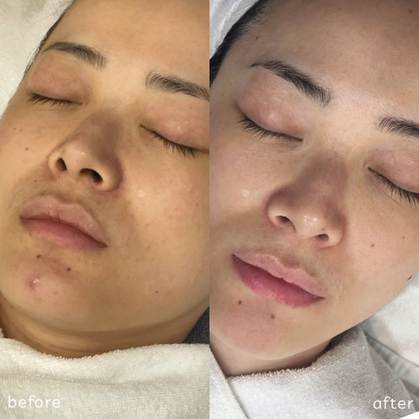 Korean skin glow results philippines